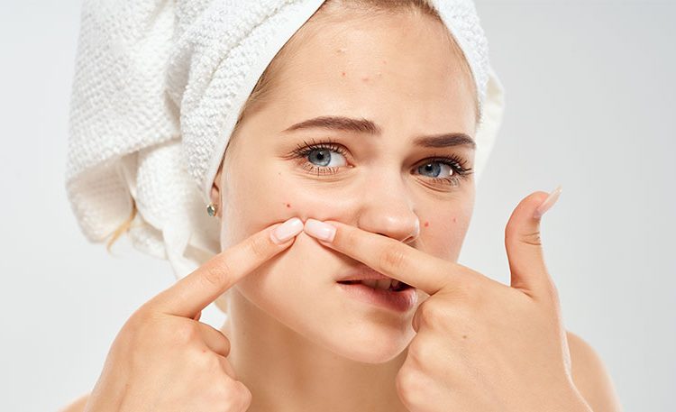 adult onset acne
