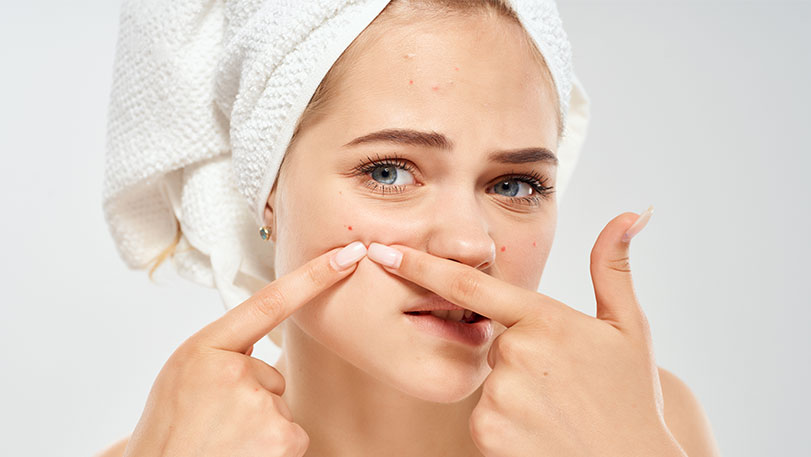 adult onset acne