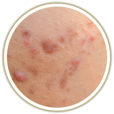 acne bubble
