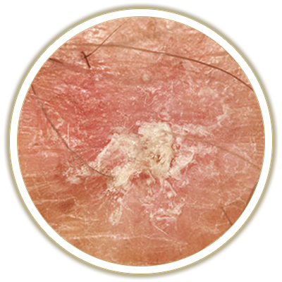 actinic bubble