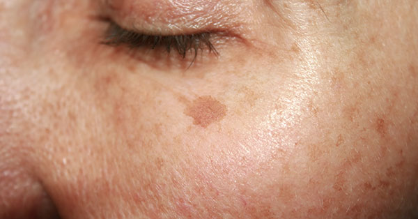 age spots