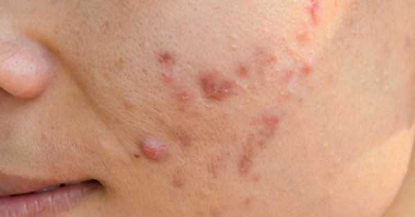 ance scars