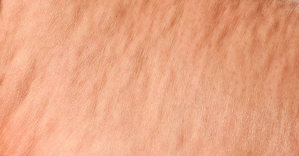 cellulite
