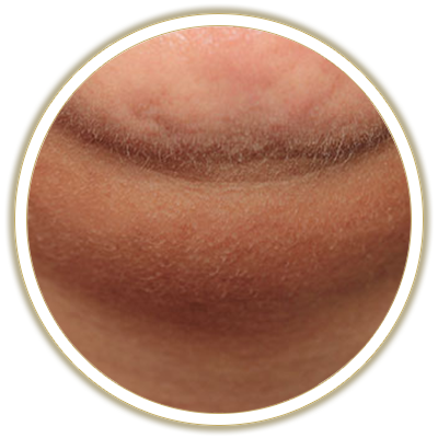 chin bubble