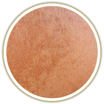 hyperpigmentation bubble
