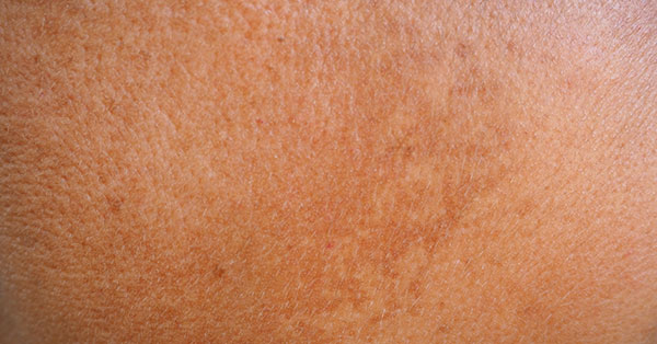 hyperpigmentation hyperpigmentation