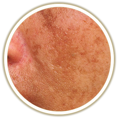 melasma bubble