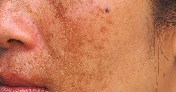 melasma melasma