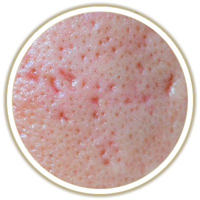 pores bubble