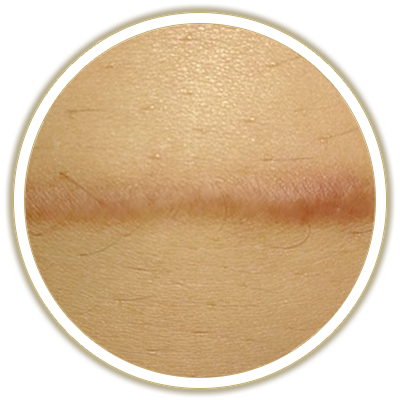 scar bubble