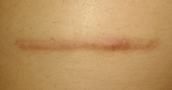 scarring scarring