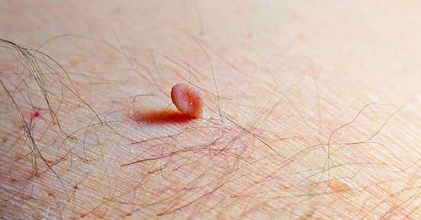 skin tag