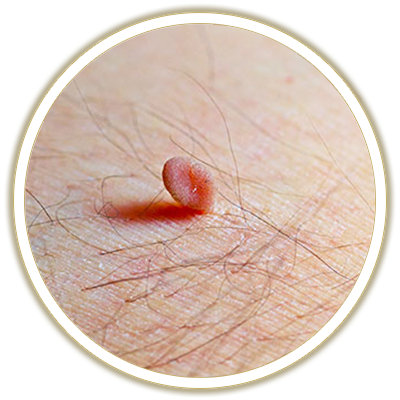 skin tags bubble
