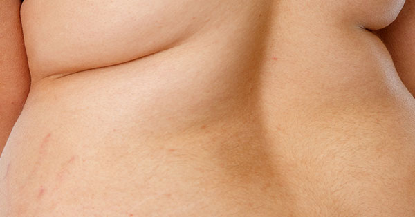 stubborn fat