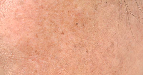 sun damage