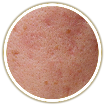 texture bubble