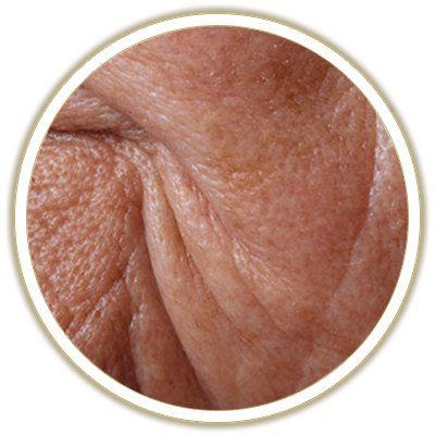 wrinkles bubble