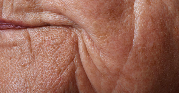 wrinkles