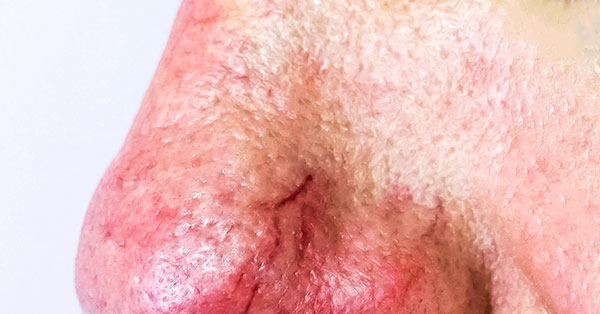 broken capillaries