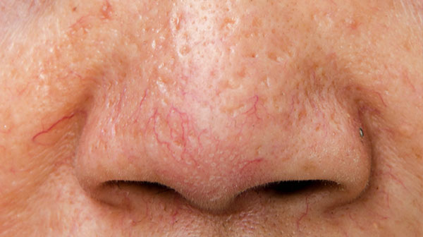broken cappillary concerns