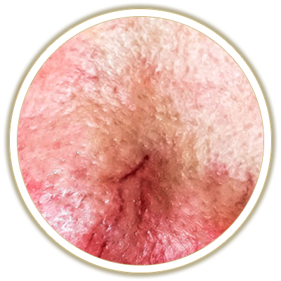 capillaries bubble
