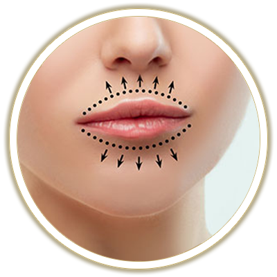 fillers ring