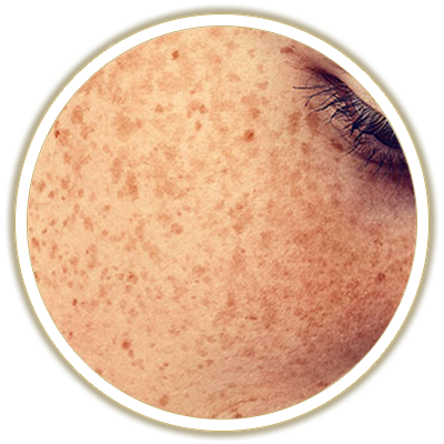 freckles bubble