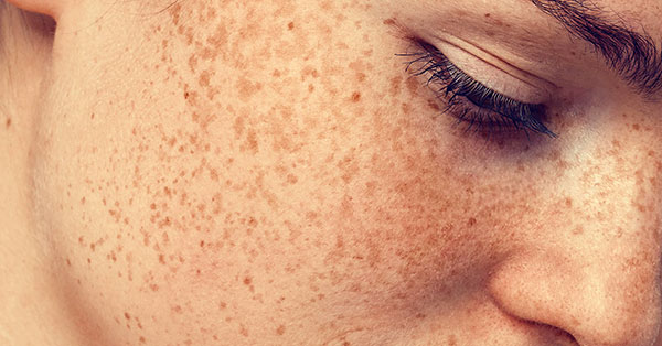 freckles