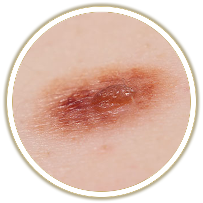 lesions bubble