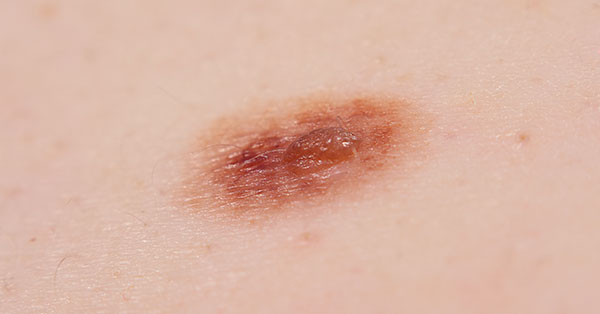 pigmented lesions