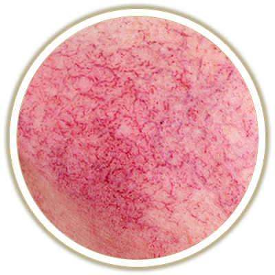rosacea bubble