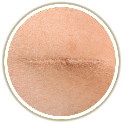 scar removal bubble