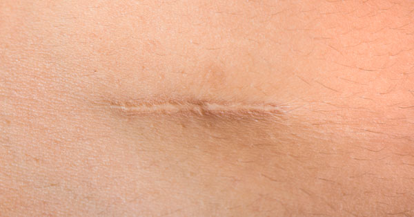 scar removal