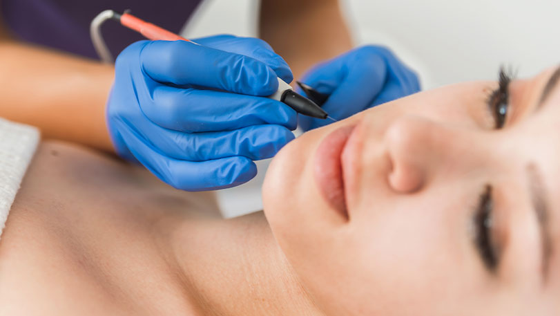 skin growth removal