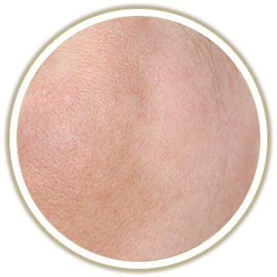 skin pigmentation buuble