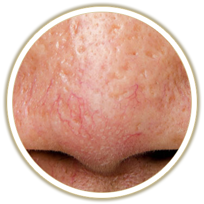 vascular lesions bubble