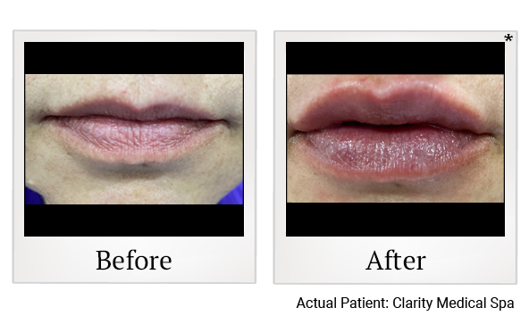 lip job before after 1