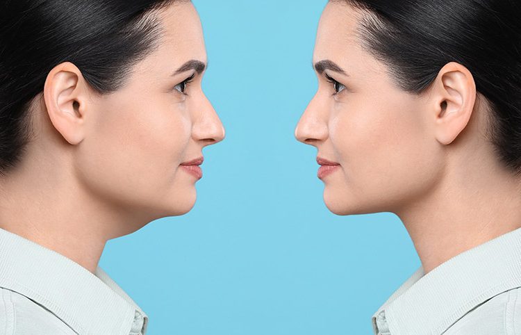 how to get rid of double chin