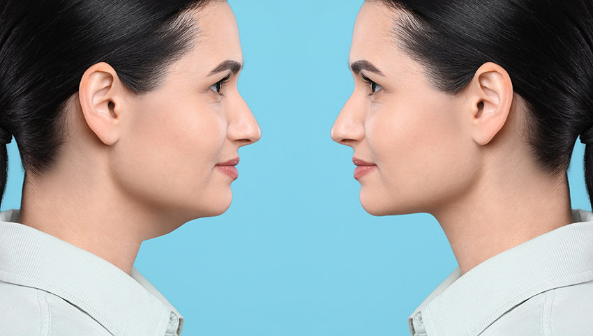 how to get rid of double chin