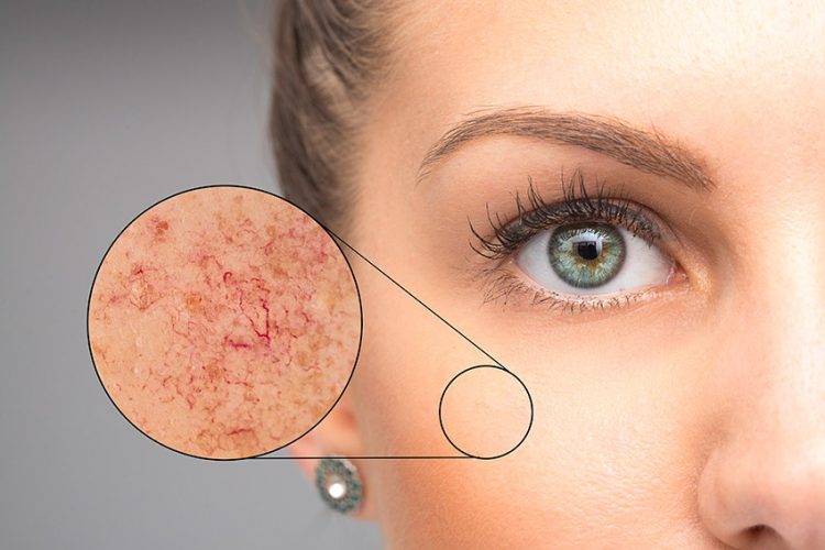 about broken capillaries san ramon