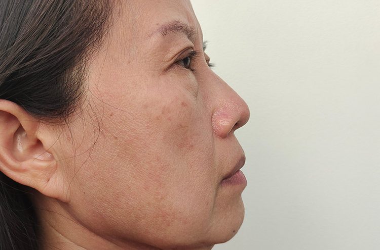 visible large pores san jose