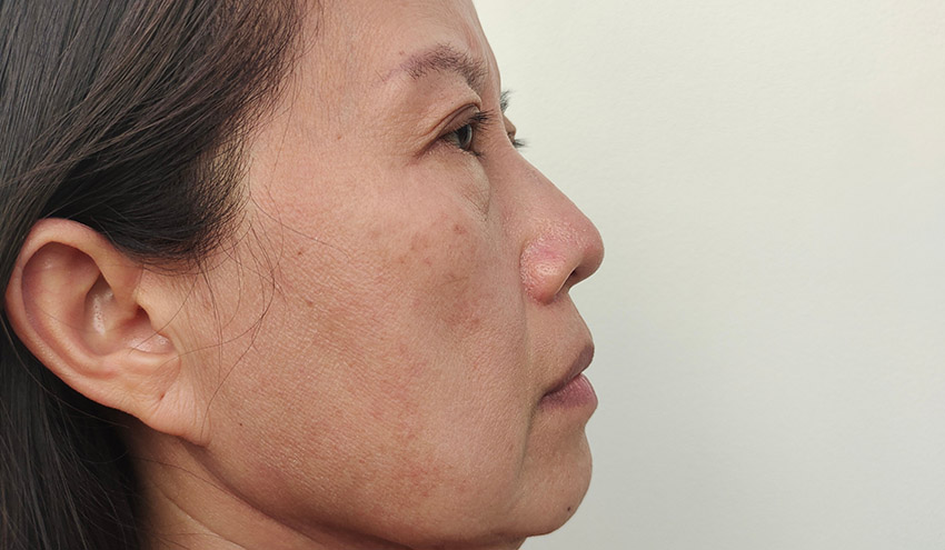visible large pores san jose visible large pores san jose