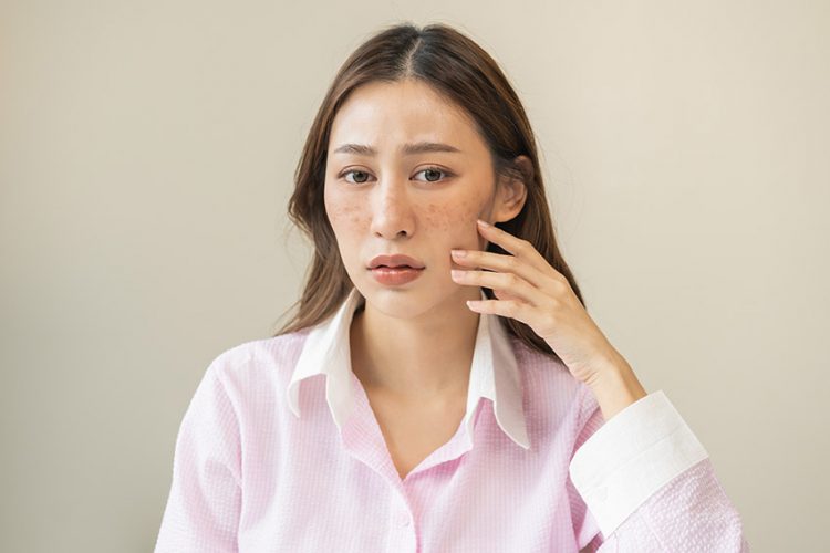 what is melasma san jose