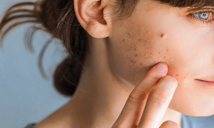 get rid of acne scars
