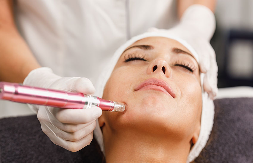microneedling