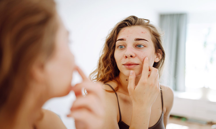 how to get rid of acne in san jose