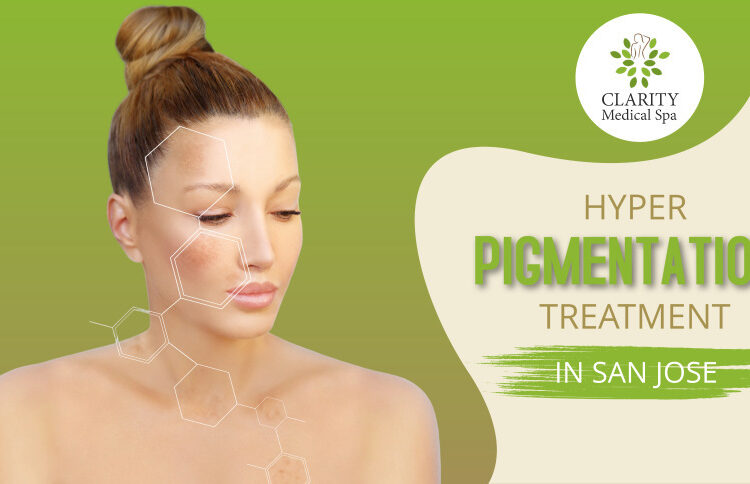 hyperpigmentation treatment in san jose