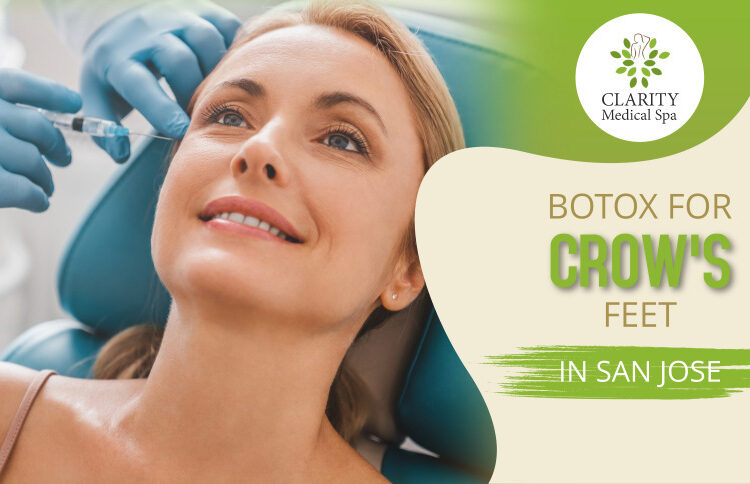 botox for crows feet in san jose