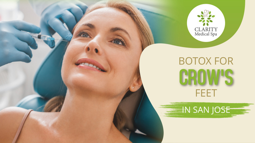 botox for crows feet in san jose