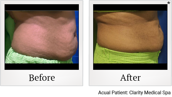 tummy tuck 2